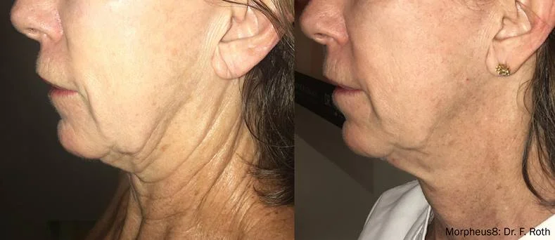 Morpheus8 acne scarring before and after — patient result at CFS London