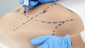 What is a Corset Trunkplasty