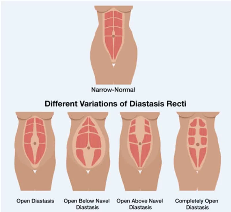 C Section Pouch - Causes, Treatment, and Prevention