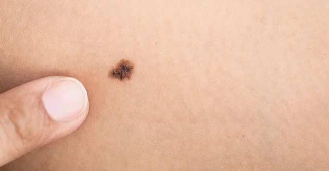 Why choose a plastic surgeon for mole removal — Centre for Surgery London