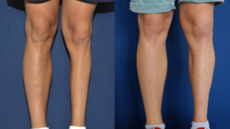 3D custom calf implant before and after — unilateral calf atrophy correction posterior view