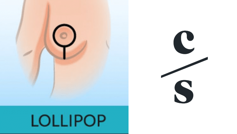 Lollipop Incision Lollipop Breast Reduction | Centre for Surgery