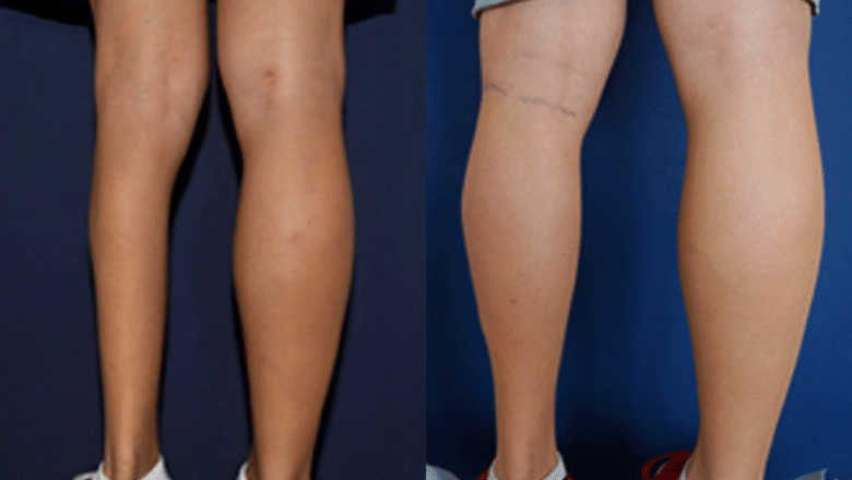 3D custom calf implant before and after — calf atrophy correction lateral view symmetry result