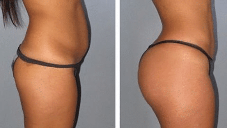 Brazilian butt lift (BBL) before and after, result 3