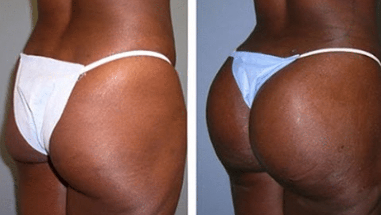 Brazilian butt lift (BBL) before and after, result 1