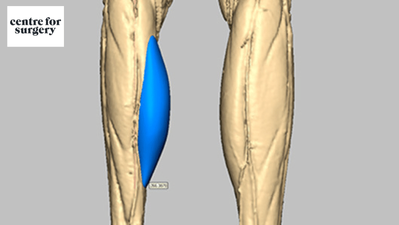 3D scan custom-designed calf implant planning — CT scan data used for Anatomik Modelling implant design