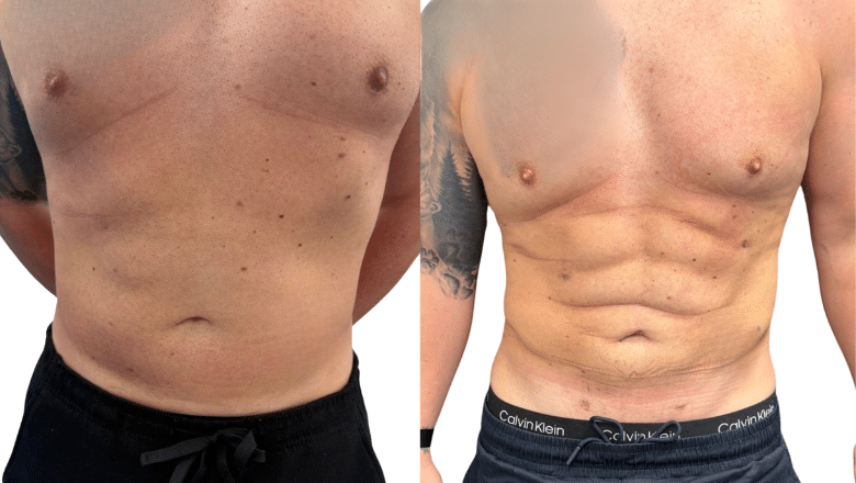 Abdominal etching before and after at Centre for Surgery London — HD lipo revealing abdominal definition and a narrower waist for a stronger V-taper