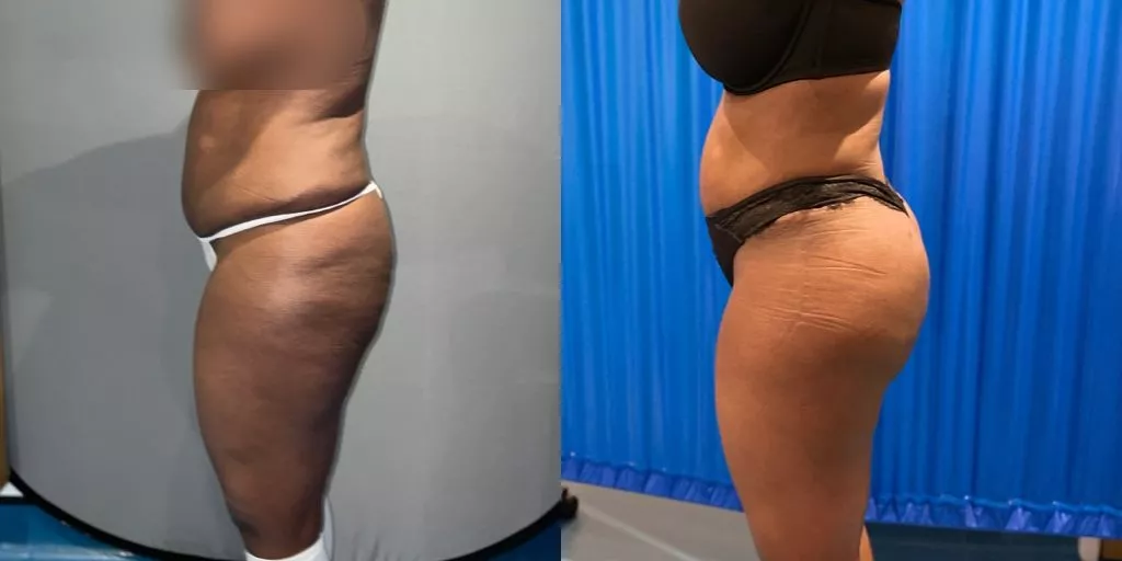 Brazilian butt lift showing buttock shape after fat transfer before and after — Centre for Surgery London