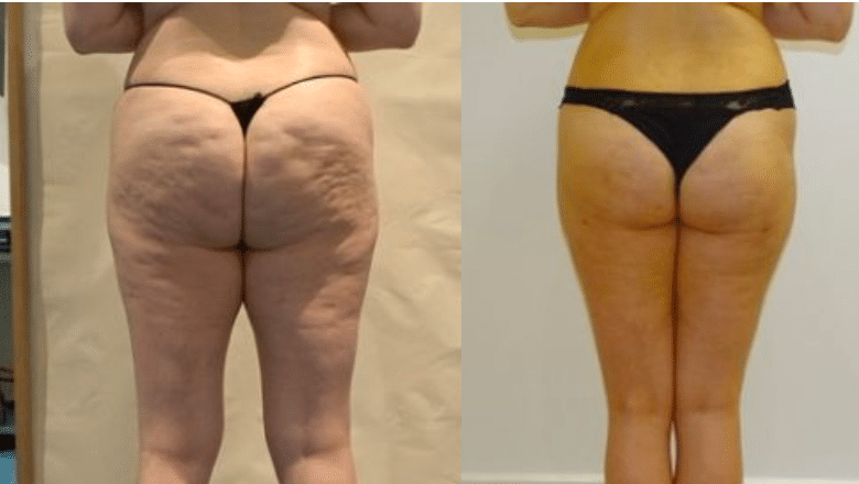CelluTite before and after showing reduction in cellulite dimpling following subcision and argon plasma skin tightening