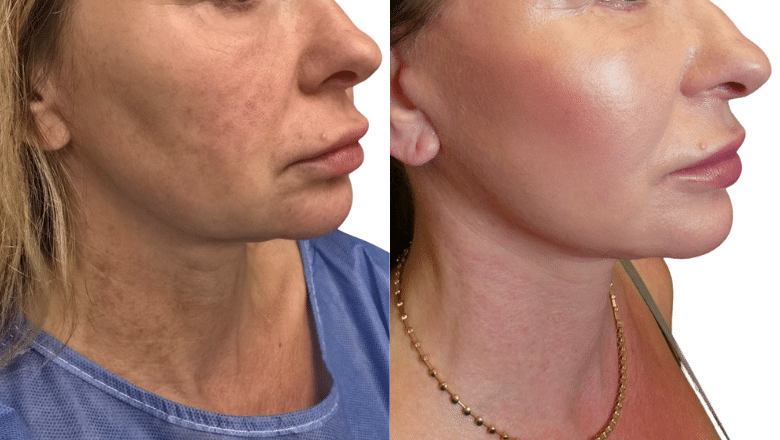 Facelift before and after, three-quarter view showing the jawline and neck, Centre for Surgery London