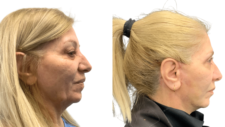 Facelift result at Centre for Surgery London showing natural rejuvenation