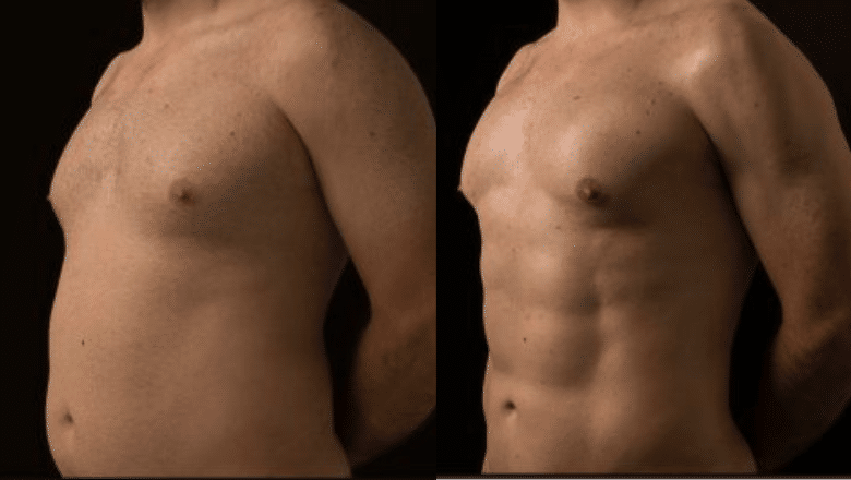 HD lipo with fat transfer to chest before and after at Centre for Surgery London — full torso VASER and power-assisted liposuction showing defined pectoral and abdominal anatomy with a narrower waist and stronger V-taper