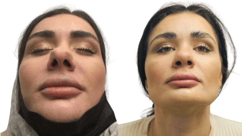 Septorhinoplasty before and after, front view showing the nostrils, Centre for Surgery London