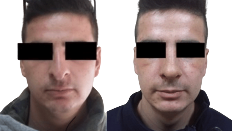 Male septorhinoplasty before and after, front view — Centre for Surgery London