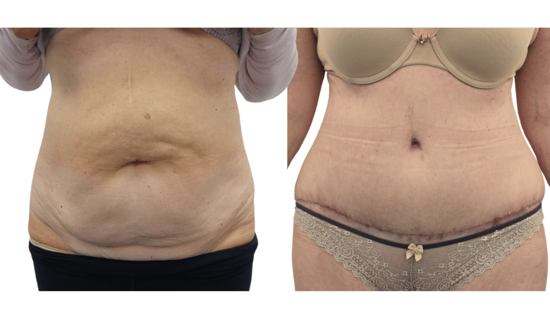 Tummy Tuck Result at Centre for Surgery London