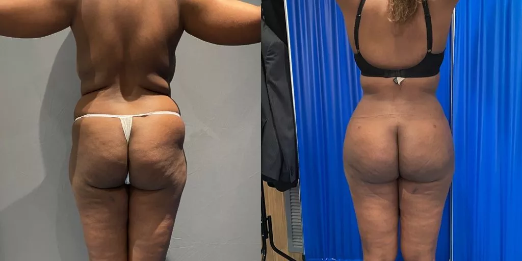 Brazilian butt lift with significant volume enhancement before and after — Centre for Surgery London