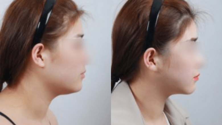 Submental liposuction before and after showing improved cervicomental angle, Centre for Surgery London