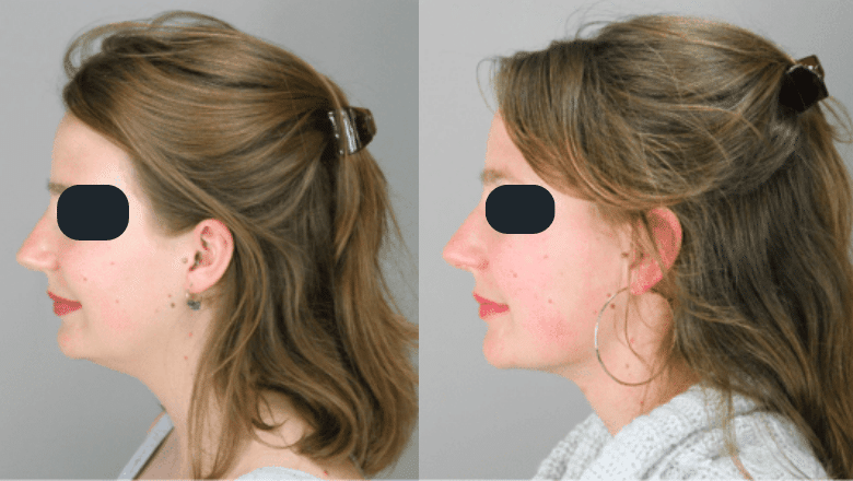 Chin and neck liposuction before and after result at Centre for Surgery London