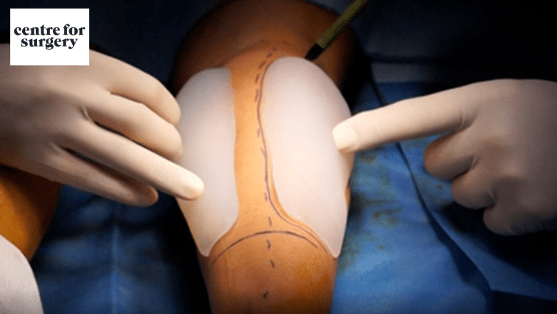 Custom calf implant surgery — 3D designed implant placement for calf atrophy at Centre for Surgery