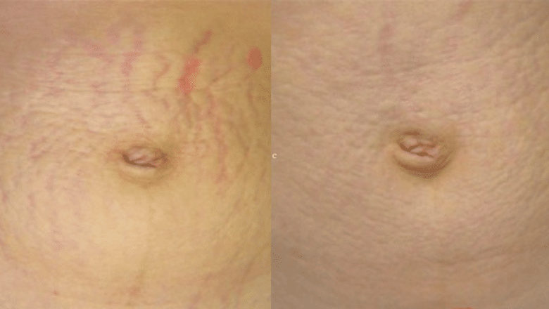 Laser stretch mark removal before and after