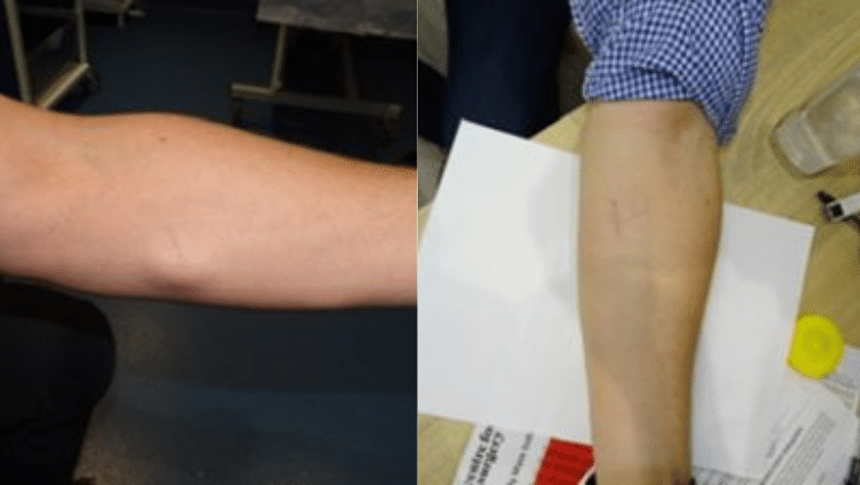 Lipoma removal from the arm, before and after, at Centre for Surgery in London