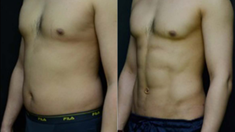 Before and after male liposuction of the abdomen and flanks, front view, showing a slimmer stomach and waist