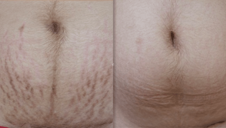 Stretch mark removal laser before and after