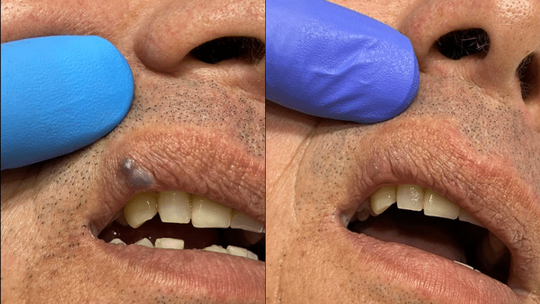 labial melanotic macule removal cost Lip Lesion London Jhet’s pick SIZE:4oz. Pilot Batch Science Behind Copper Peptides