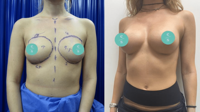 Breast augmentation with implants before and after at Centre for Surgery London
