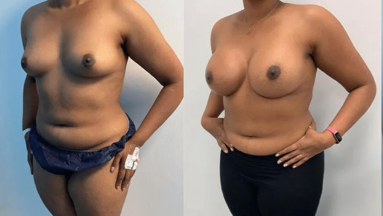Breast augmentation with implants before and after at Centre for Surgery London