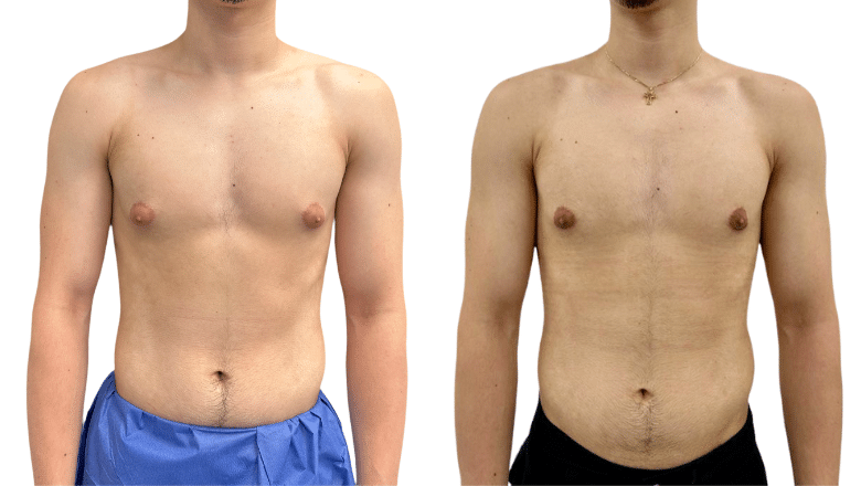 Gynaecomastia surgery before and after, front view of a male chest, Centre for Surgery London