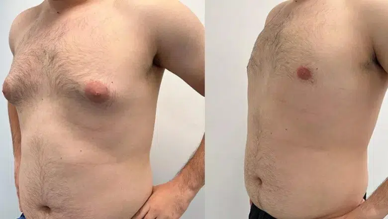 Different Grades of Gynecomastia | Centre for Surgery