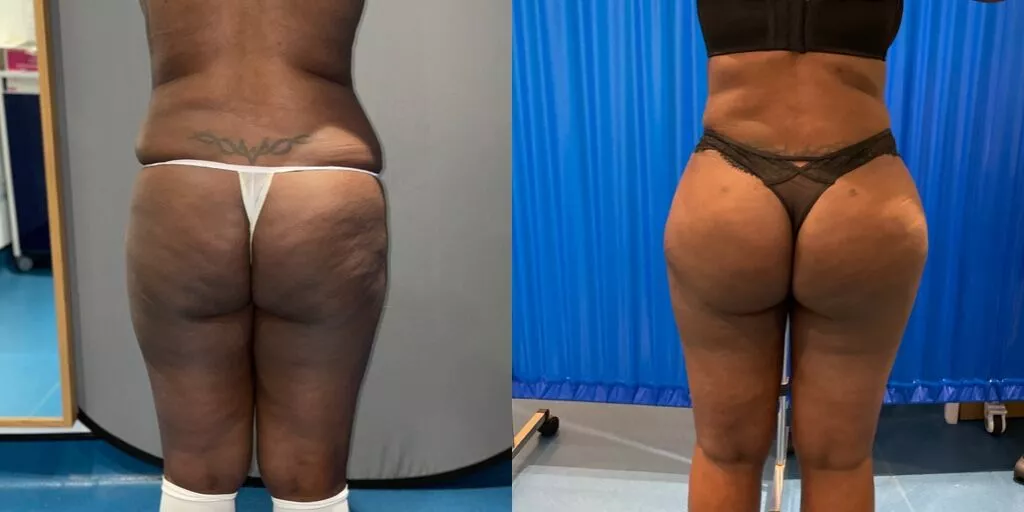 Brazilian butt lift with increased buttock volume and a natural waist-hip curve before and after — Centre for Surgery London