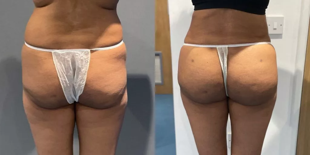 Brazilian butt lift with a fuller natural-looking buttock contour before and after — Centre for Surgery London