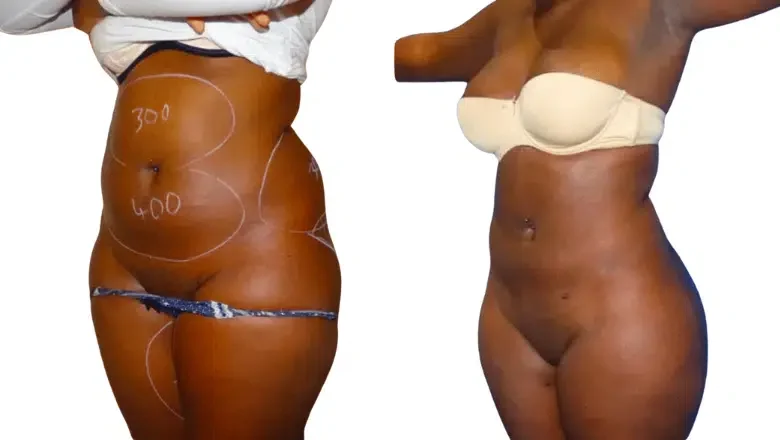 Lipo 360 and BBL | Centre for Surgery Lipo 360 and BBL | Centre for Surgery
