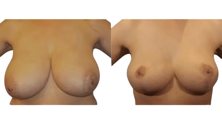 Breast reduction before and after photos, front view