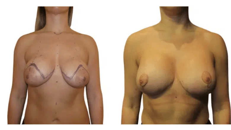 Breast uplift before and after at Centre for Surgery London
