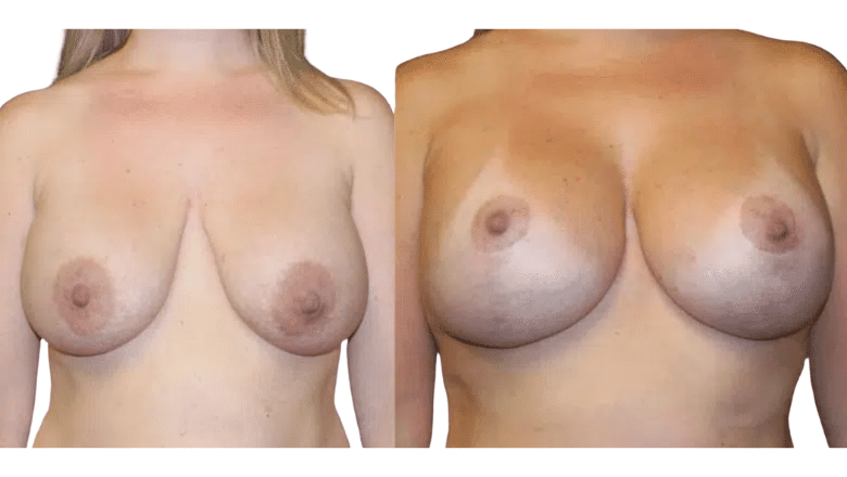 Breast uplift before and after at Centre for Surgery London