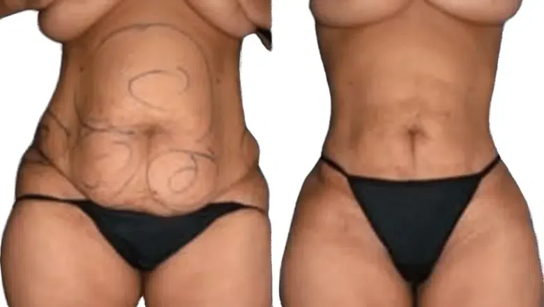 What are Liposuction Side Effects?