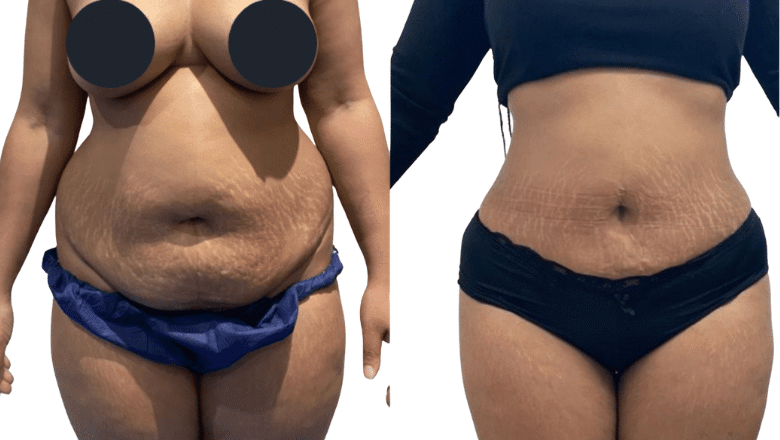 side effects of lipo c Liposuction Effects: Common vs Rare Risks CAMEL MEDICATIONS & HEALTH Flavor:Orange Pineapple Glutathione IV Dose: Practical