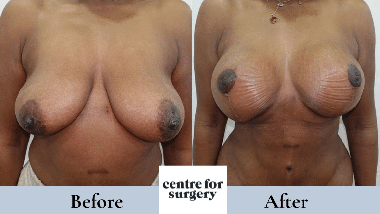 Breast uplift with implants before and after at Centre for Surgery London