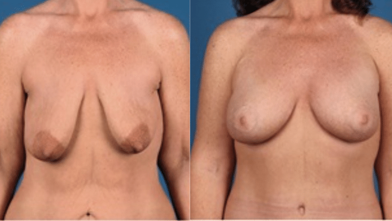 Breast uplift mastopexy before and after at Centre for Surgery London