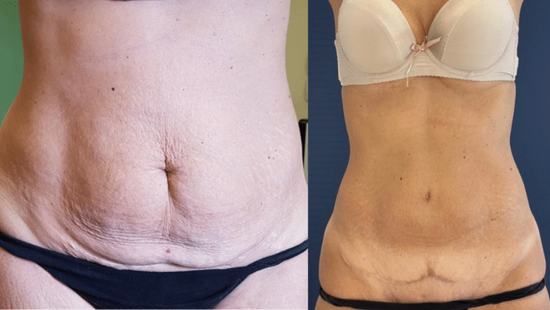 Belly Overhang After C-Section