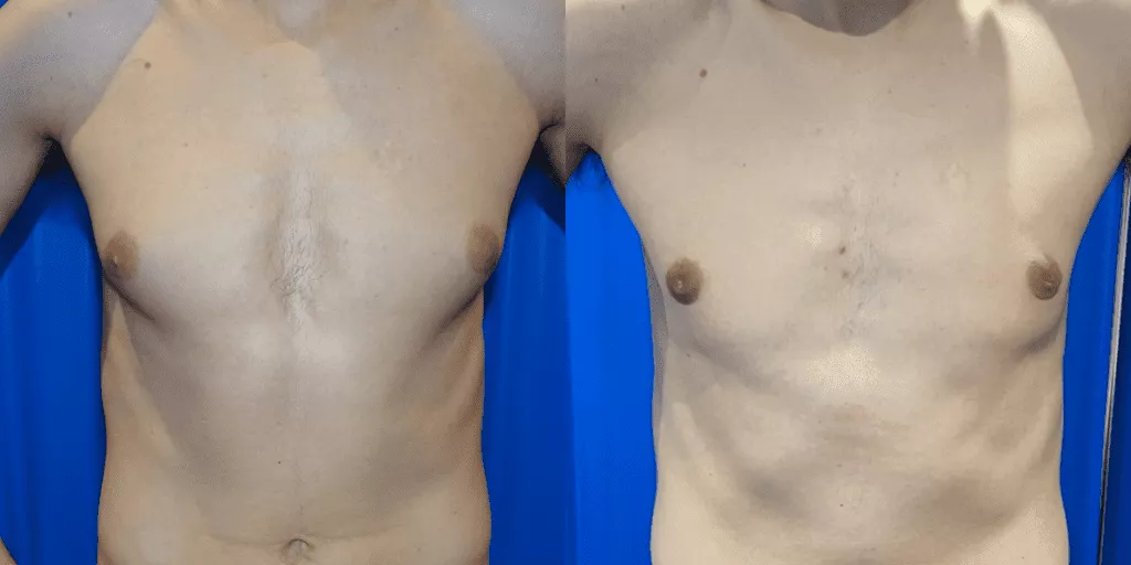 Gynecomastia Removal Results | Centre for Surgery Gynaecomastia removal before and after photos