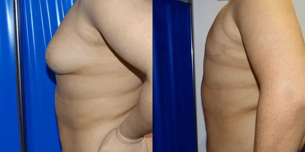 Gynaecomastia surgery before and after, chest contour