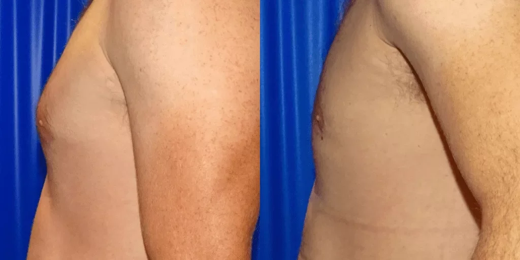 Gynecomastia Before and After | Centre for Surgery Gynaecomastia before and after photos