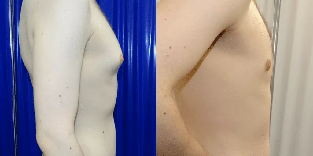 Gynecomastia Removal Side View | Centre for Surgery Gynaecomastia surgery before and after photos, side view