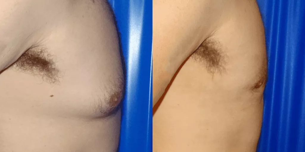 Gynecomastia surgery results before and after