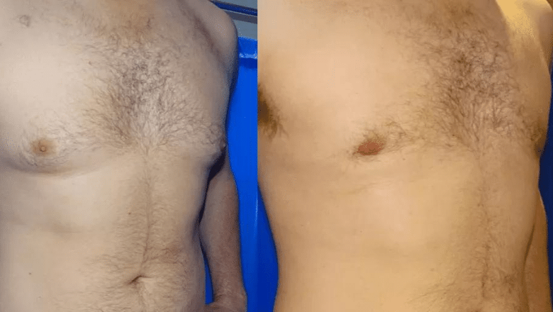 Glandular gynaecomastia in a lean man before and after gland excision and liposuction, front view, Centre for Surgery patient