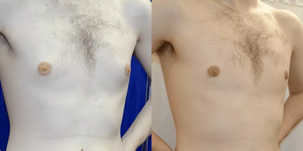 can smoking cigarettes cause gynecomastia Can Cannabis Cause Gynecomastia?